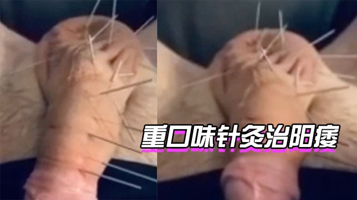 针灸治阳痿，你想试下吗